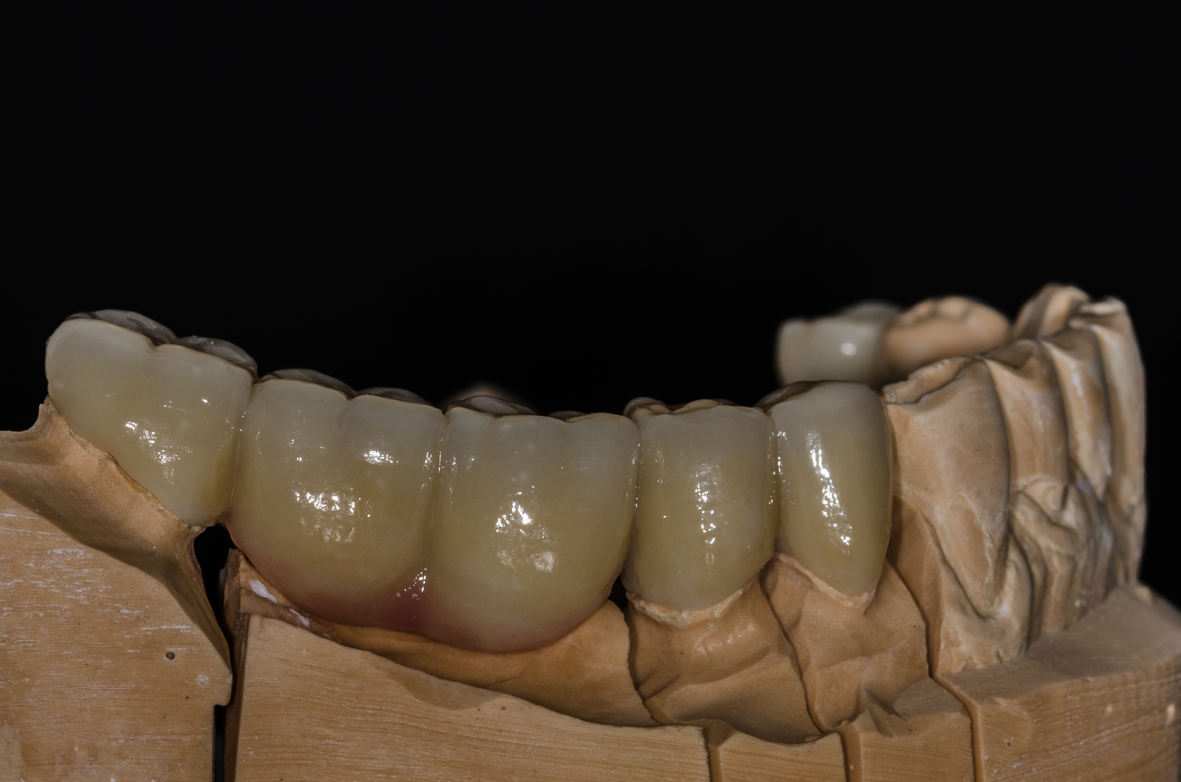 Neišimami dantų protezai, kruminiai dantys