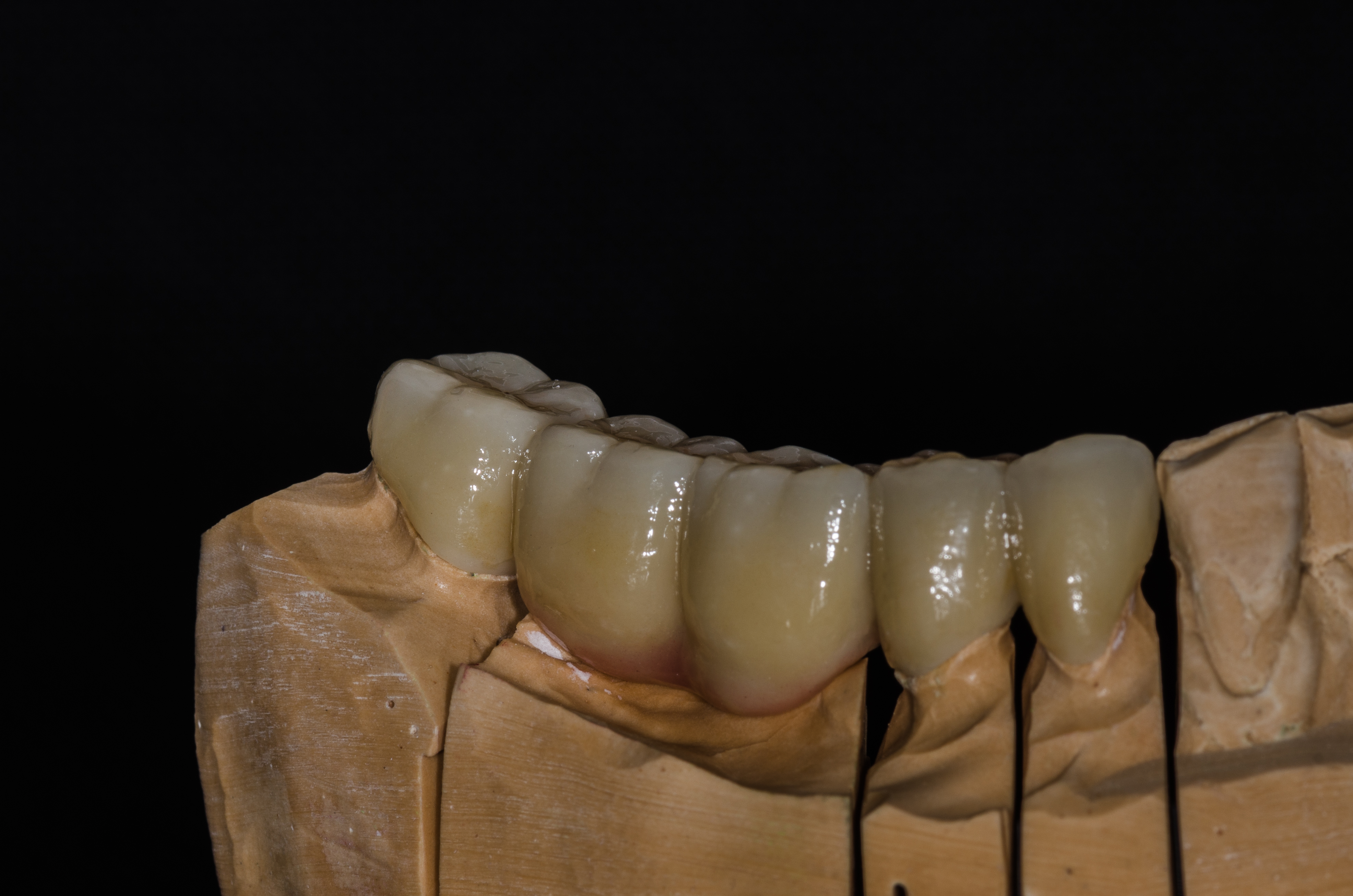 Dantų protezų gamyba, kruminiai dantys,
