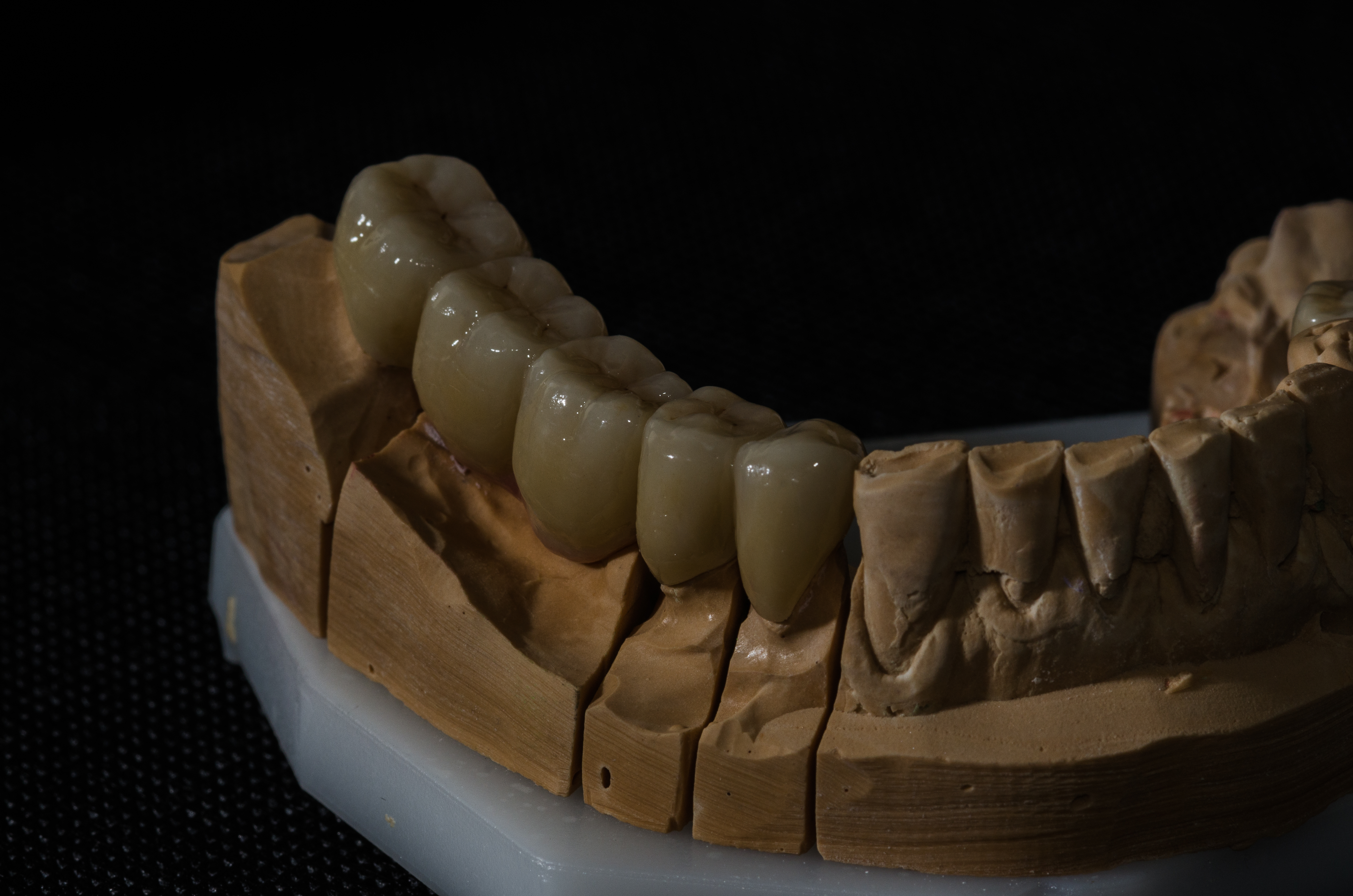 Neišimami dantų protezai, dantų protezų gamyba, cirkonio keramika,