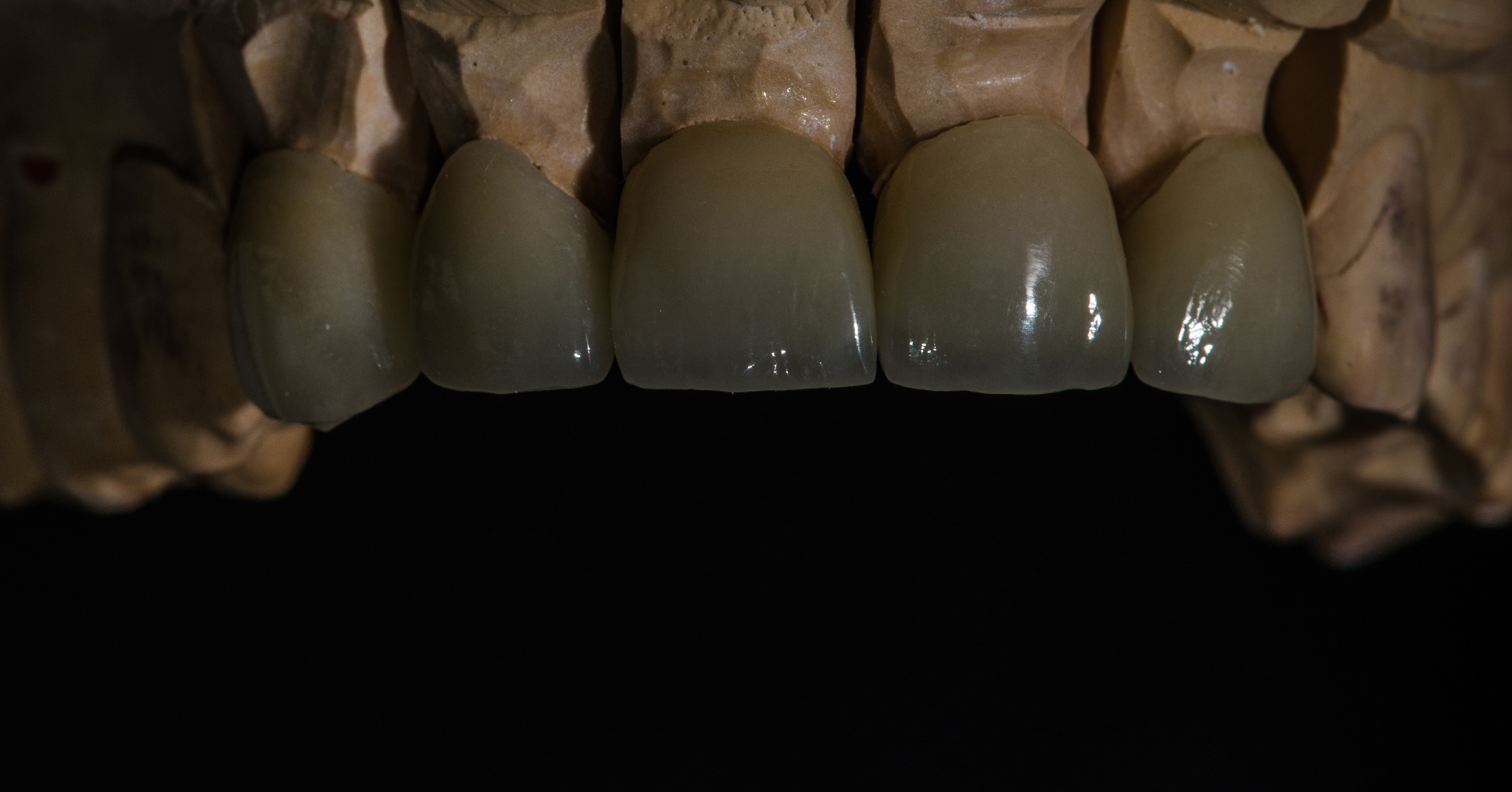 Cirkonio keramika, priekiniai dantys, dantų protezų gamyba Vilniuje,