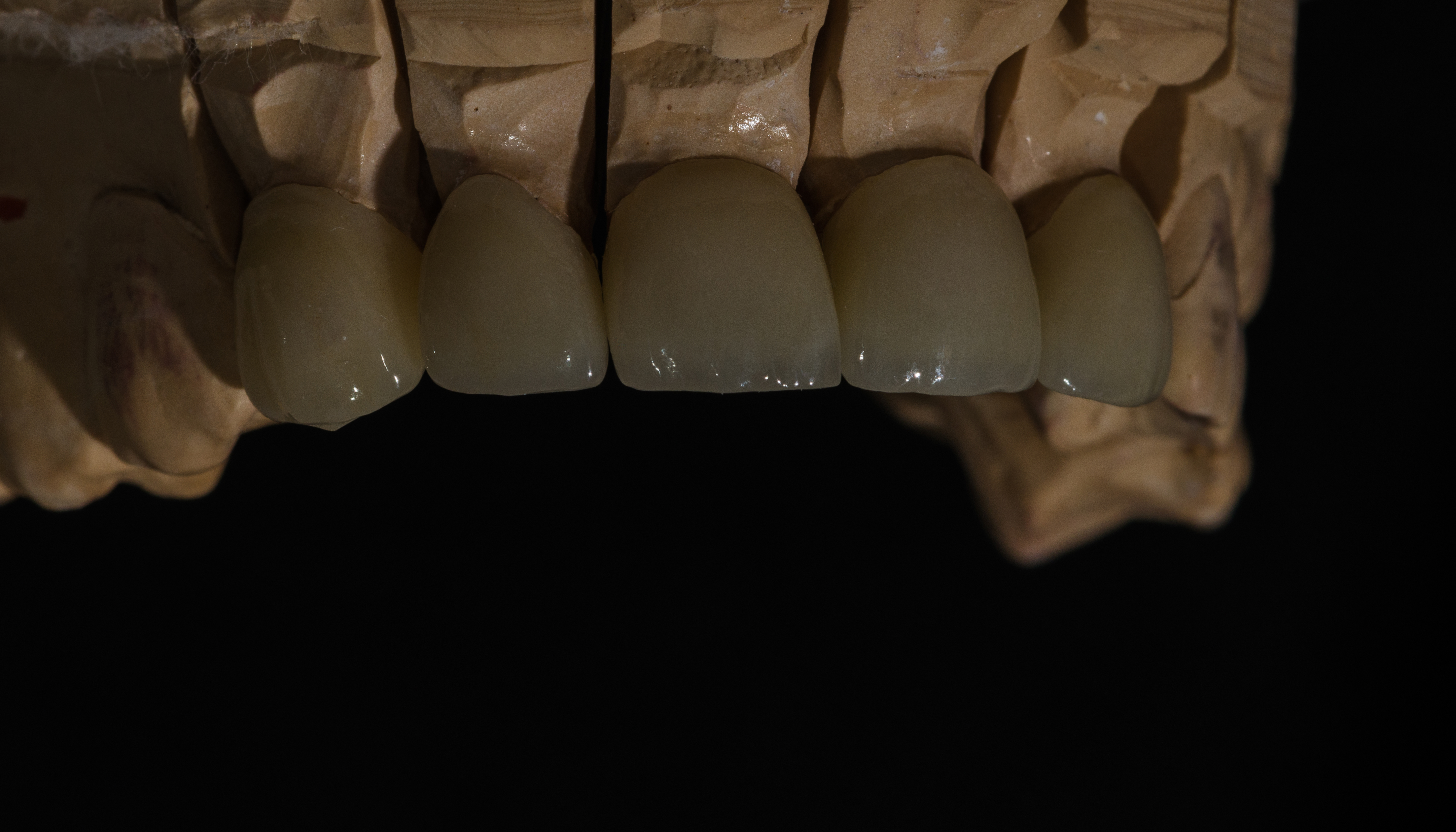 Neišimami dantų protezai, priekiniai dantys, cirkonio keramika,