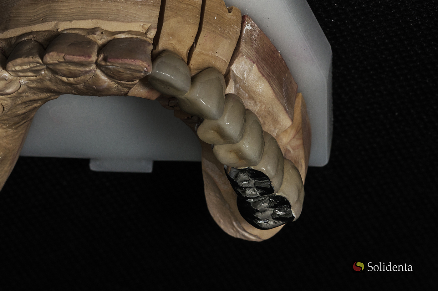 Metalo keramikos dantų protezas, krūminiai dantys, kaina sutartinė