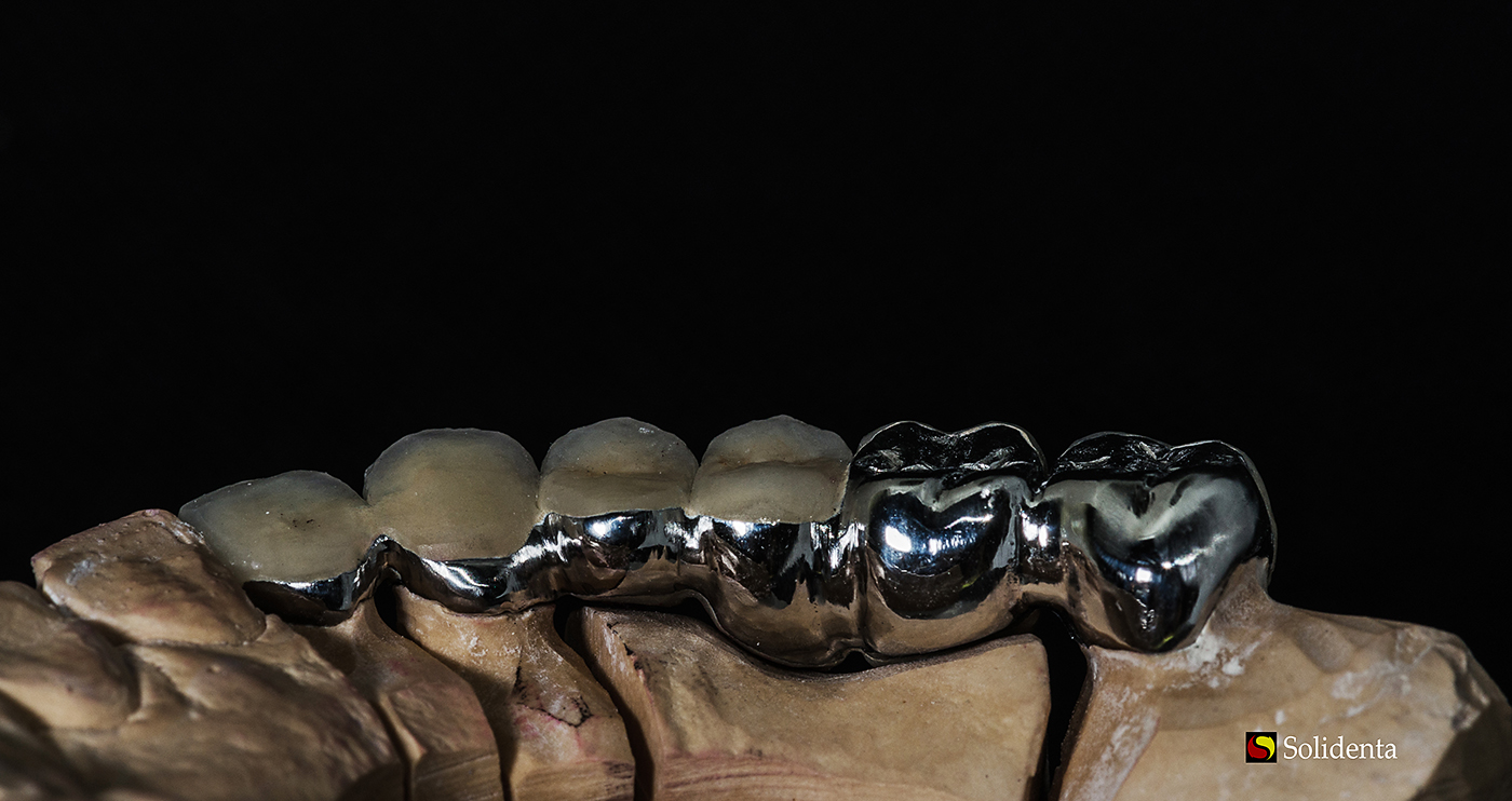Metalo keramikos dantų protezas, krūminiai dantys,