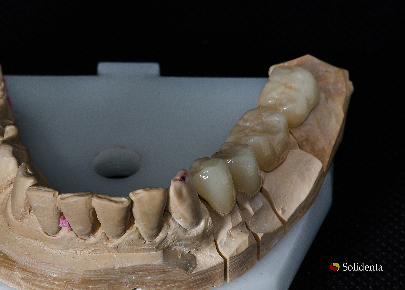 Cirkonio keramikos tiltas, kruminiai dantys, fiksuotu dantu protezu gamyba