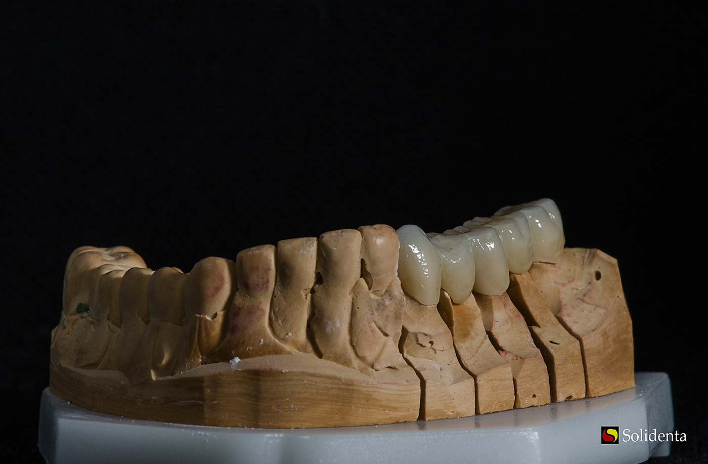 Cirkonio keramikos tiltas, dantu technikas Kristupas Endriušaitis, dantu protezu gamyba Vilniuje