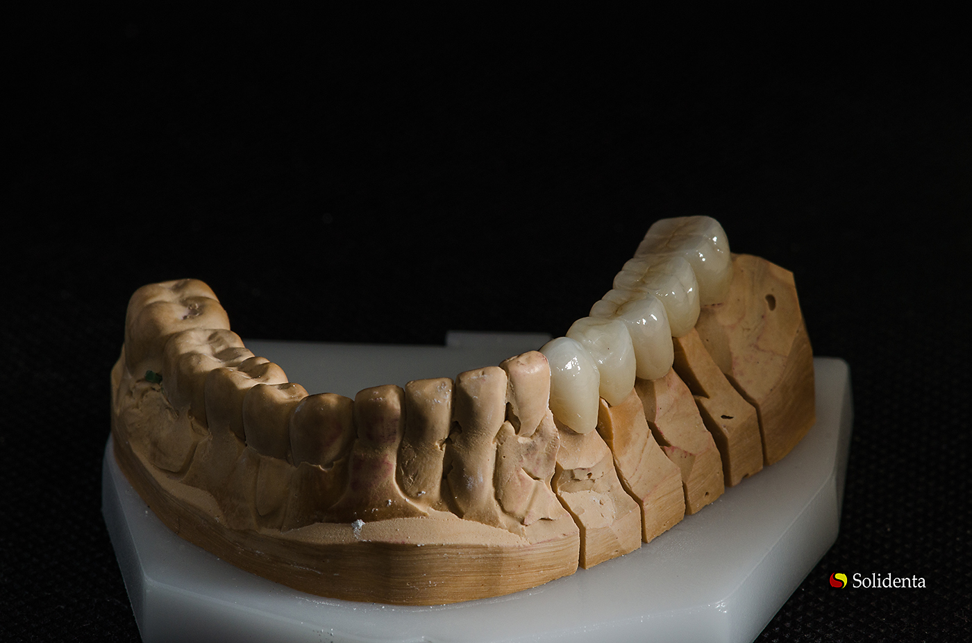 Cirkonio keramika, kruminiai dantys