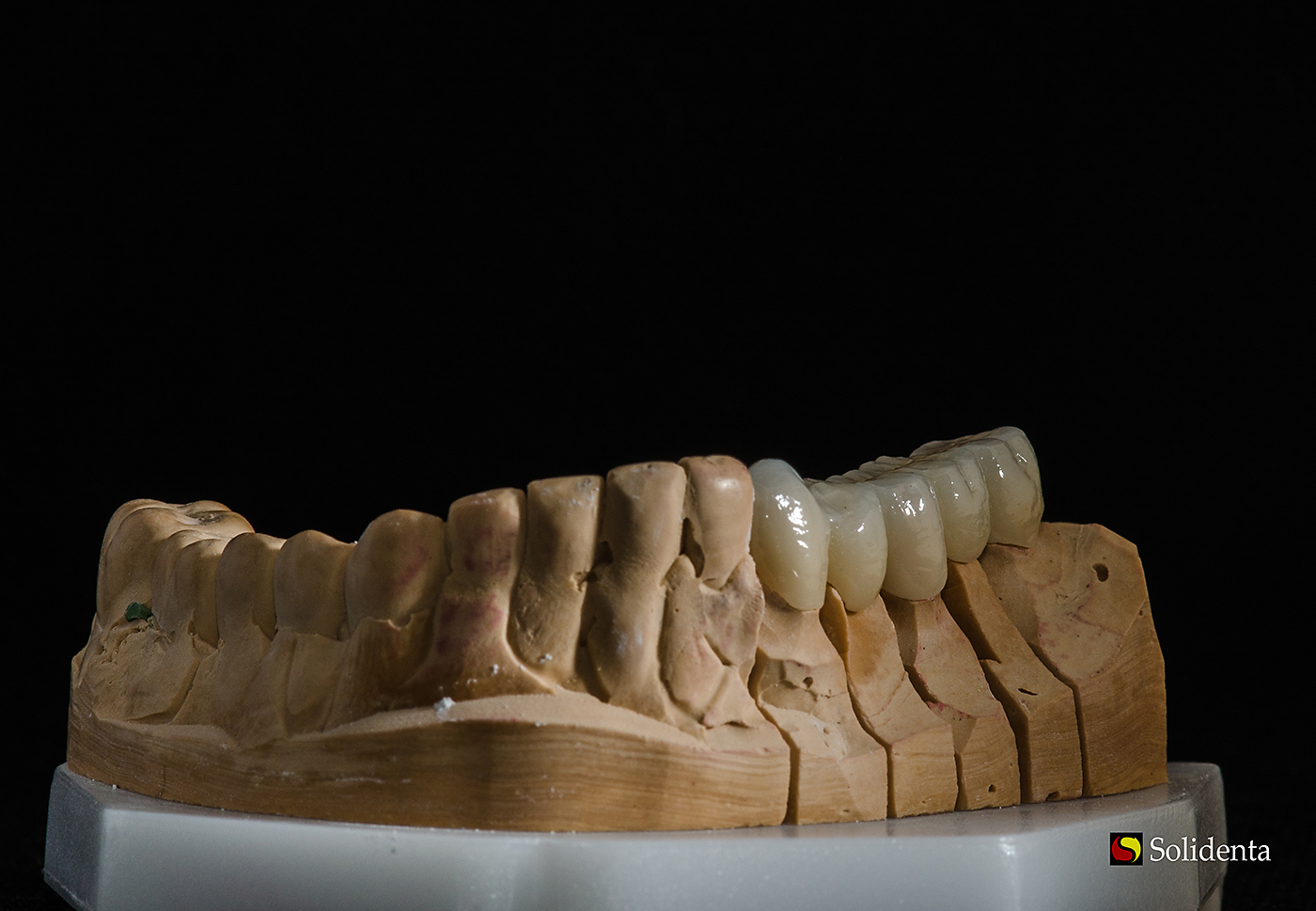 Cirkonio keramikos dantų protezas,