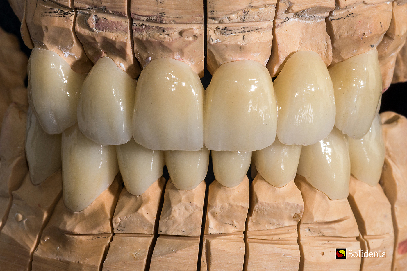 Cirkonio keramikos tiltas, priekiniai dantys, dantų protezų gamyba. Dantų technikas Kristupas Enriušaitis